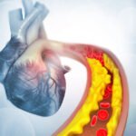 Environmental Factor - September 2024: Chelation therapy may reduce blood lead levels, but not heart attacks
